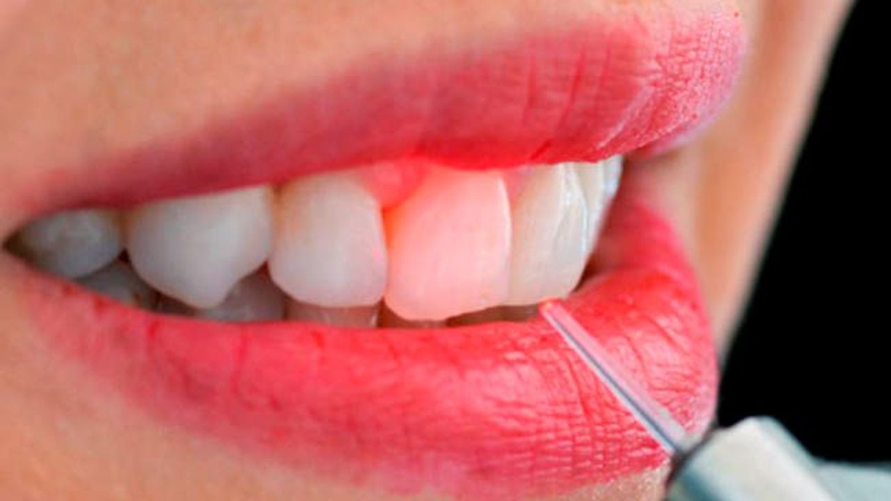 Diş eksikliğine dikişsiz implant alternatifi