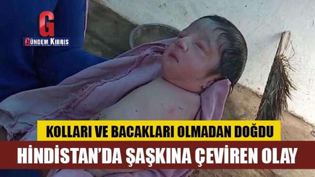 Hindistan’da kolları ve bacakları olmadan doğan bebek şaşkınlığı