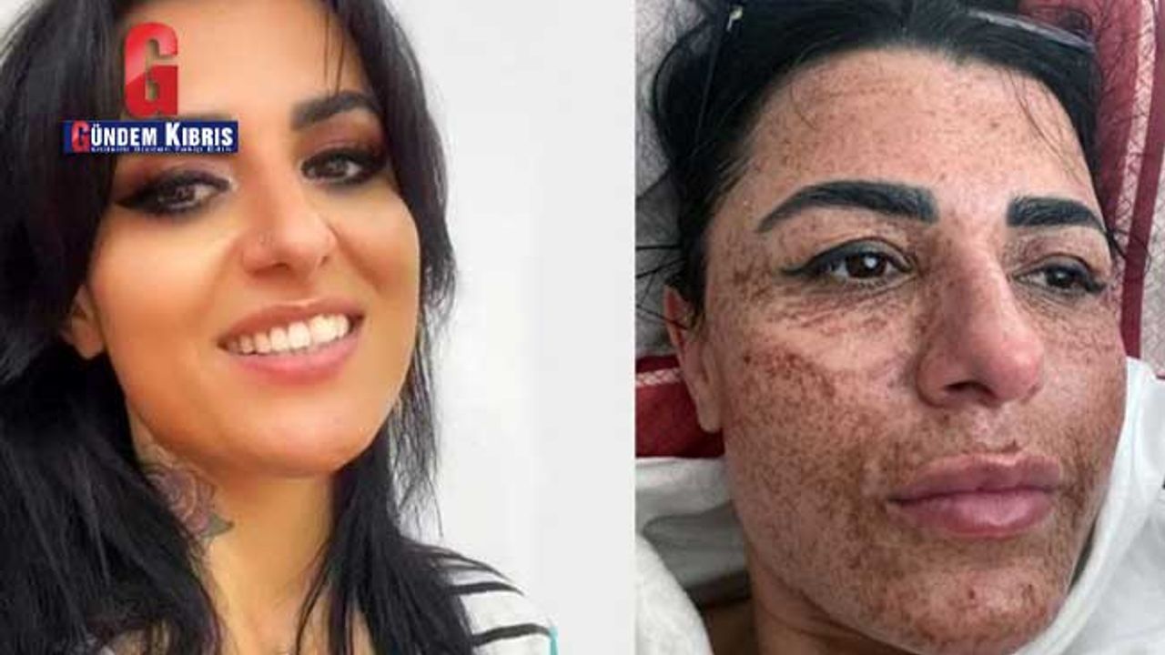 Güzellik merkezinde yüzü yanan Aslı: Sosyal medyadaki reklamlarına kandım