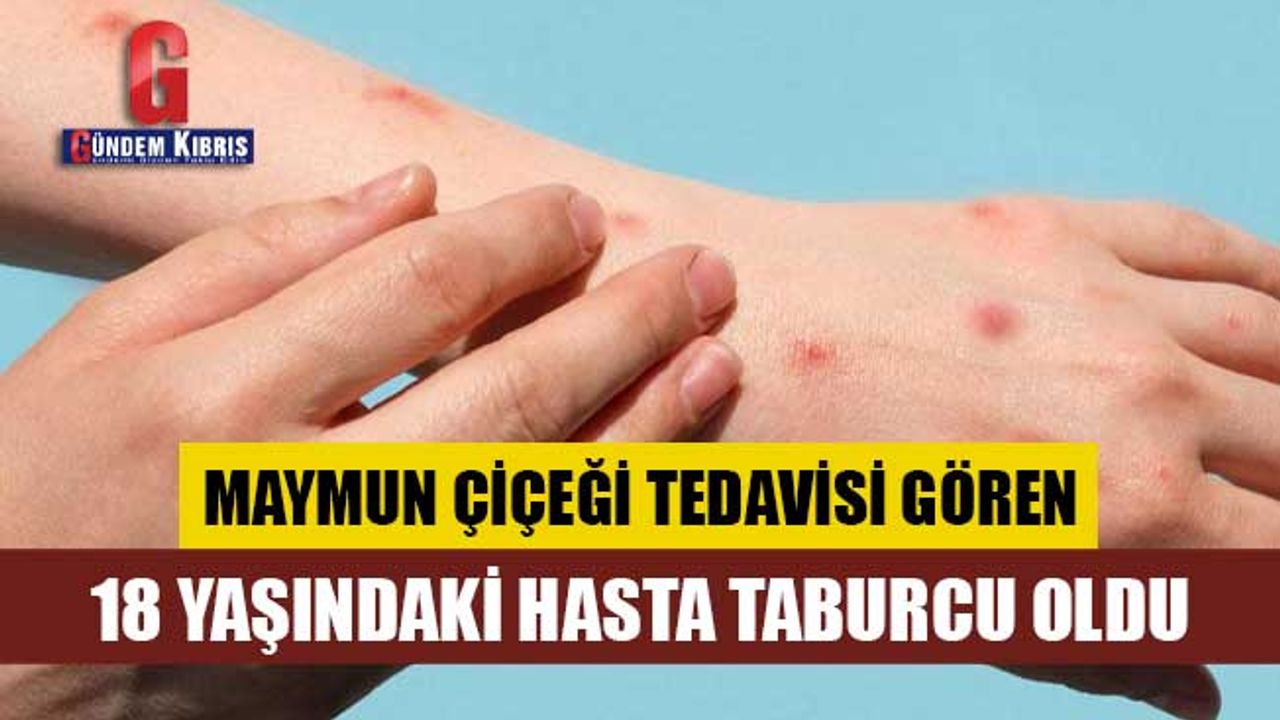 Maymun çiçeği tedavisi gören 18 yaşındaki hasta taburcu oldu