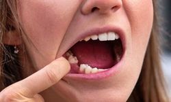 Dişleri nedeniyle ilk iş gününde işten çıkarıldı