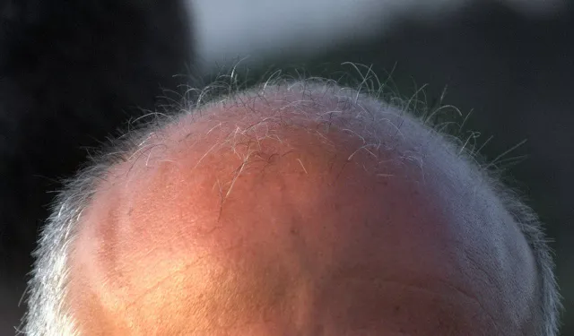 Tıp tarihinde dönüm noktası: Erkek tipi kellik için ilaç bulundu