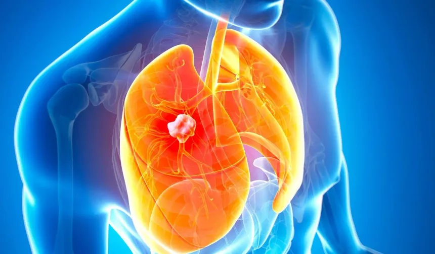 Akciğer kanserinin en erken evresini saptayabilen kan testi geliştirildi